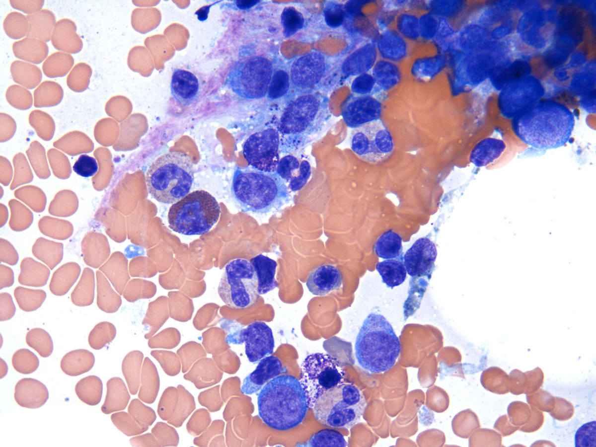 Bone Marrow aspirate_5